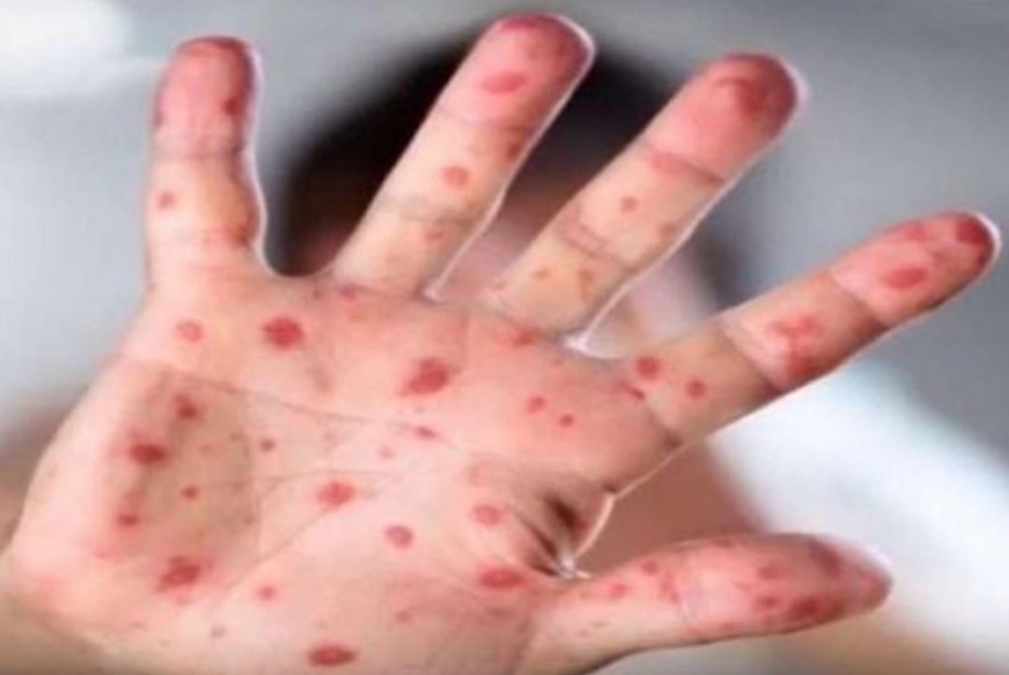 Na području Kantona Sarajevo proglašena epidemija morbila