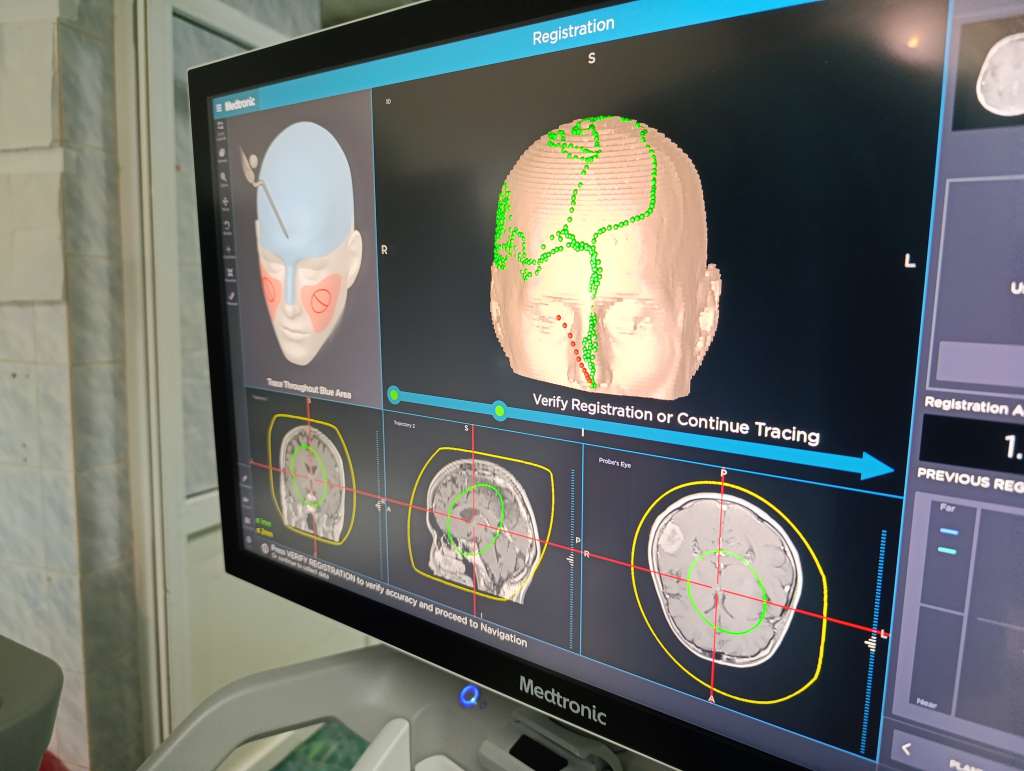 Veliki uspjeh zeničkih neurohirurga: Operacija tumora mozga novim uređajem